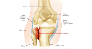Fractures of Knee