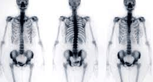 Skeletal Scintigraphy