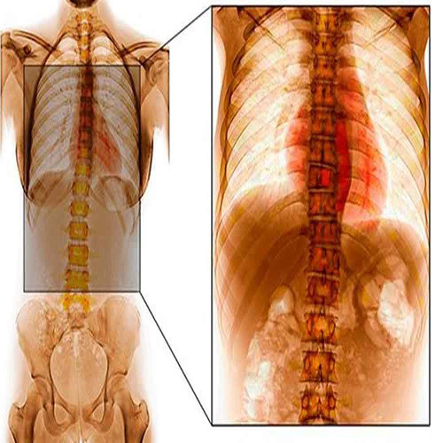 Spine tuberculosis