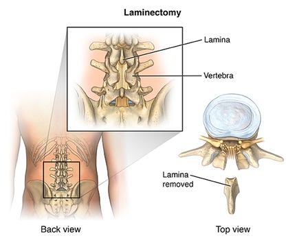 Laminectomy Surgery
