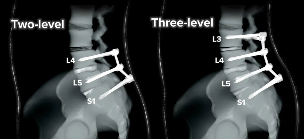 Multilevel spinal fusion